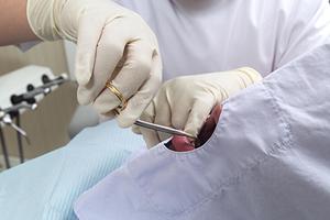 セラミックインレーの特徴とメリット